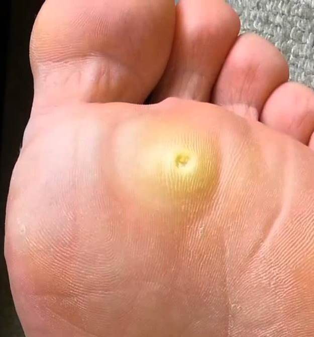 verruca foot pain toxins quartile